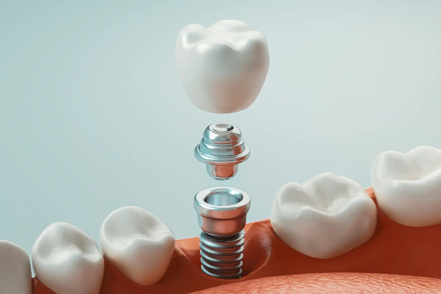 69790df7edeb921bcfac0e2e_Dental Implants