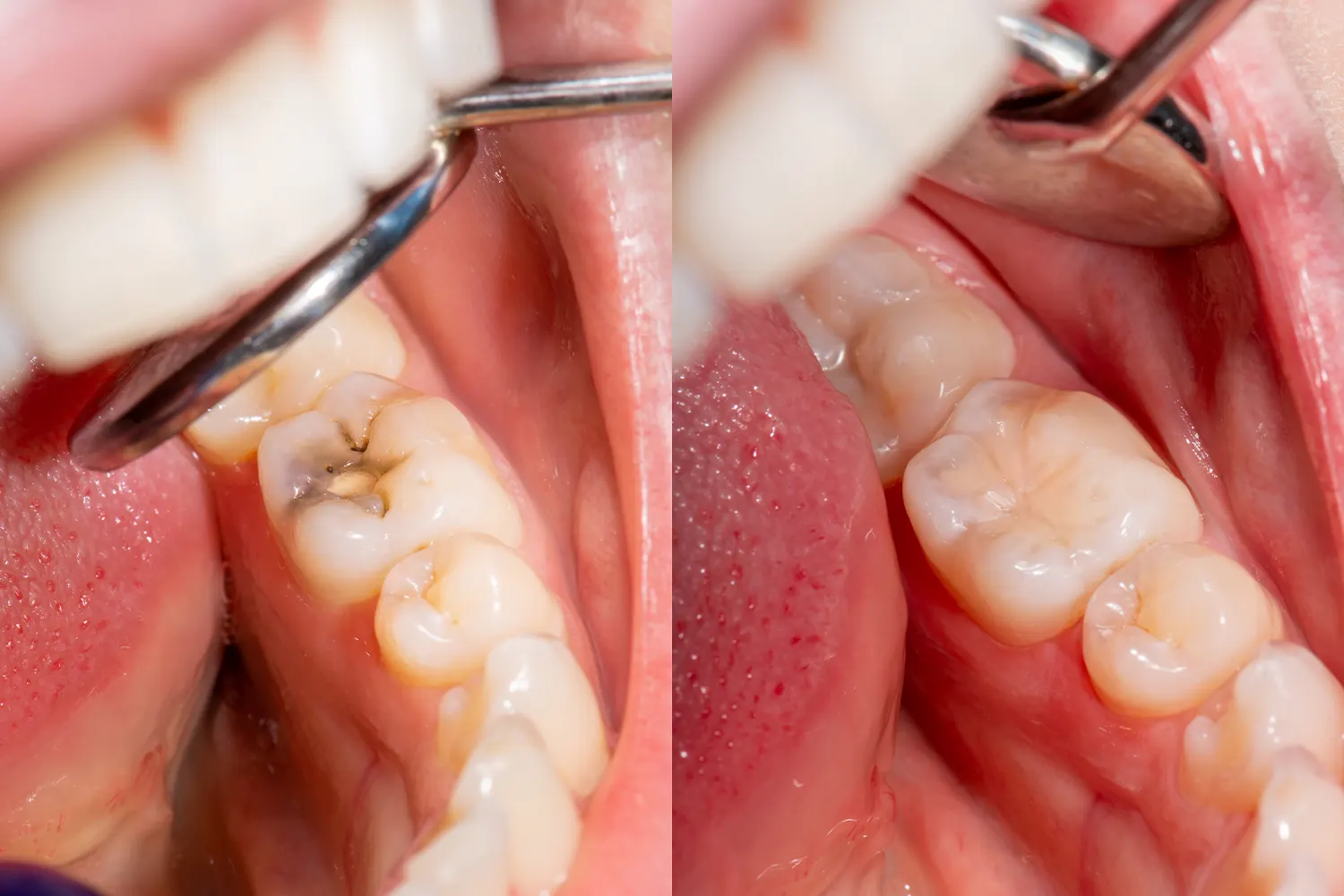 6a1cee8781b18d9459c28e2b_Dental Filling